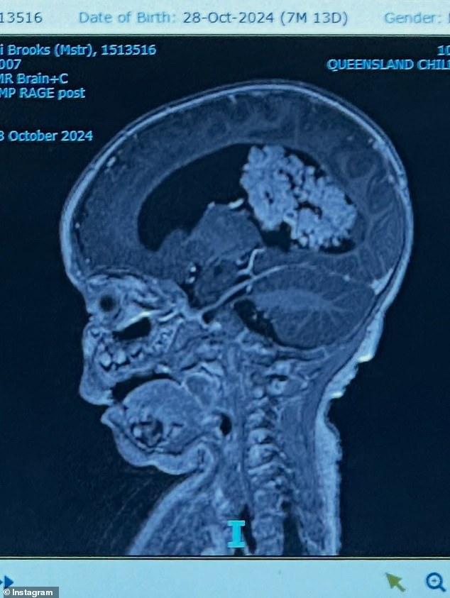A scan, conducted earlier this week, revealed the shocking diagnosis - a large brain tumour located on the right side of his brain