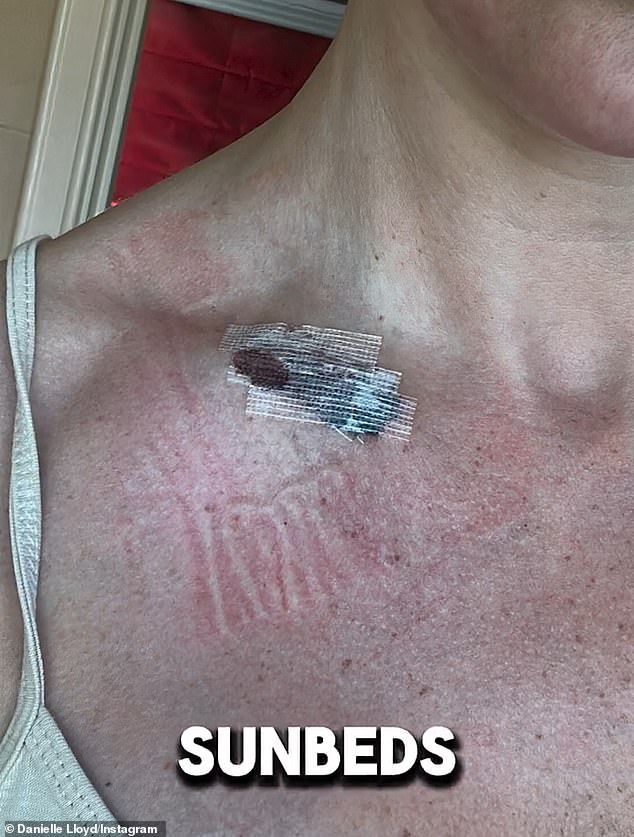 Symptoms of melanoma include a new mole or changes to an existing mole, which is exactly what happened to the star, when she noticed one on her collarbone was changing shape