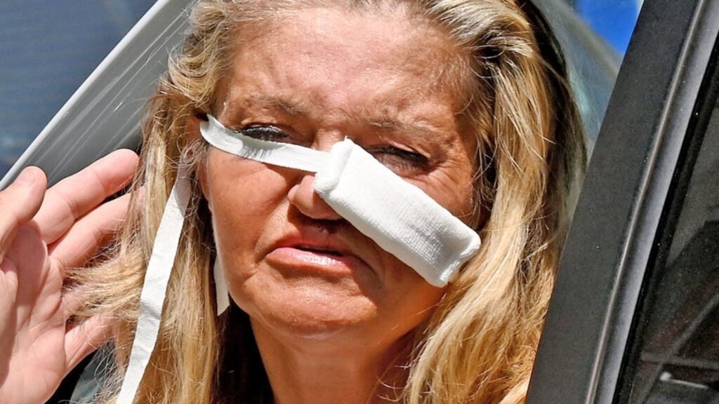 Danniella Westbrook seen in bandages after surgeons use cartilage from her rib to fix her nose in life changing op