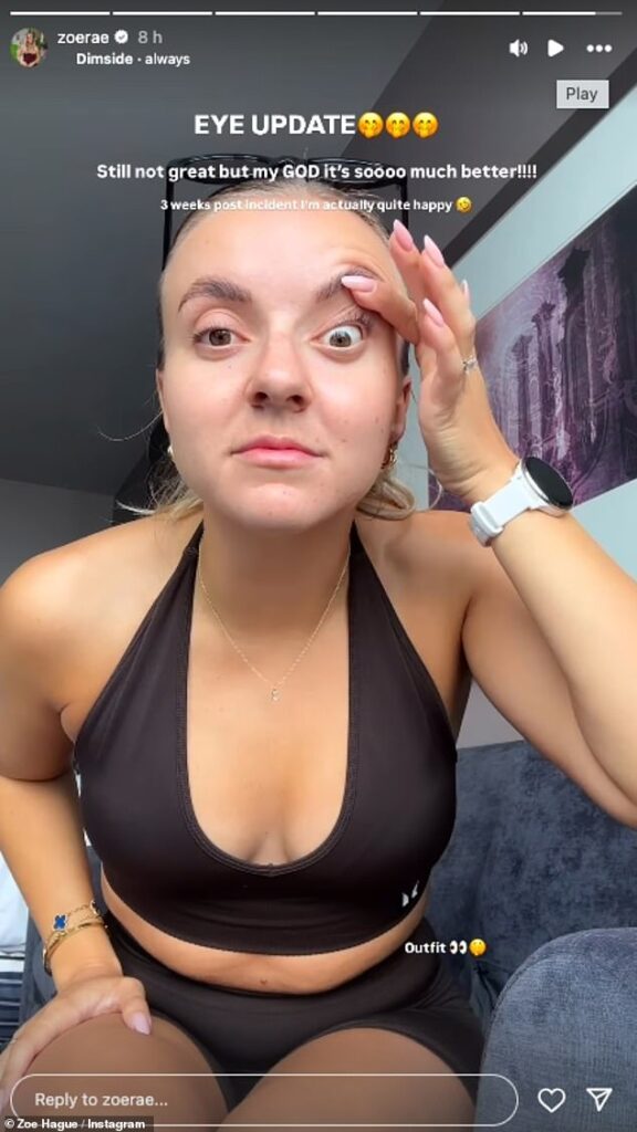 Molly-Mae Hague's sister Zoe gave her followers an update on her botched Botox in a new clip posted to her Story on Wednesday