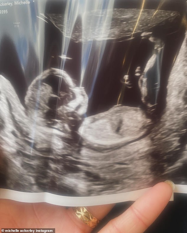 In an update this week she shared some more details and said that it was 'amazing' to be pregnant after her battle with endometriosis