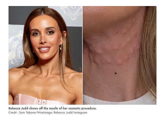 The publication ran with the headline: 'Model Reveals Neck Covered in Swollen Bumps After Undergoing Cosmetic Procedure to Copy Kris Jenner's Youthful Look.'