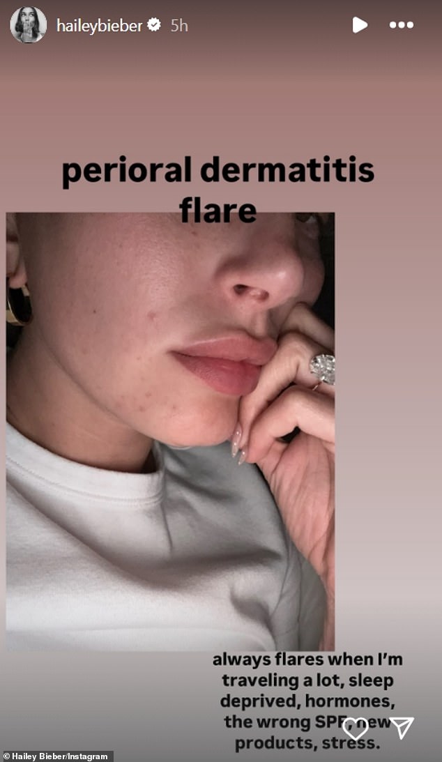 The mom-of-one revealed that she has been suffering from a 'perioral dermatitis flare' and uploaded a close-up selfie to show redness around her chin
