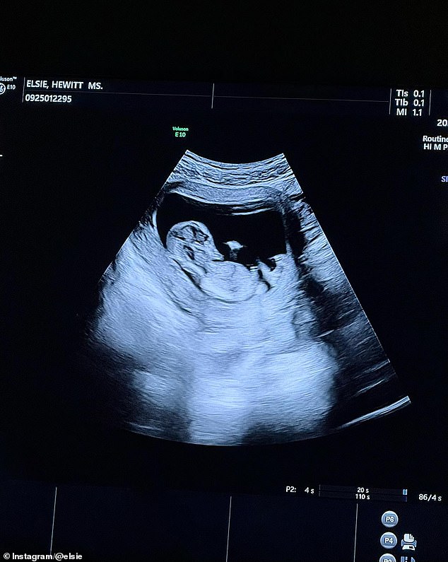 Hewitt additionally included an ultrasound of their baby and other pictures showed the lovebirds celebrating the pregnancy