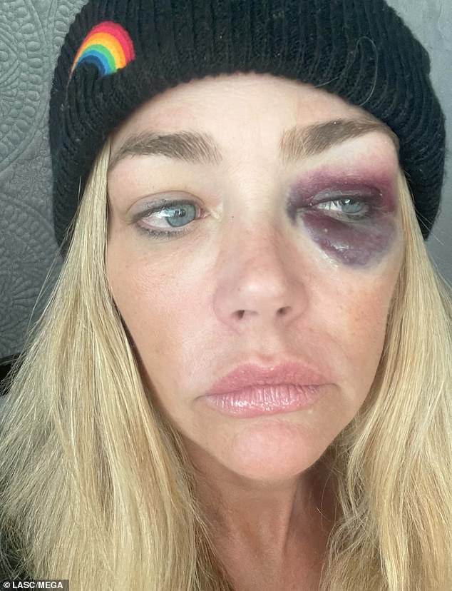 After Phypers filed for divorce, Richards hit back with an avalanche of abuse allegations from Richards in court documents, including that he had left her with a black eye - which he says was actually the result of a drunken fall
