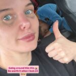 Helen Flanagan sported a painful black eye after undergoing a £400 beauty treatment this week