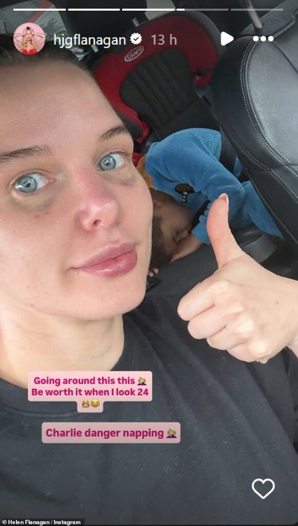 Helen Flanagan sported a painful black eye after undergoing a £400 beauty treatment this week