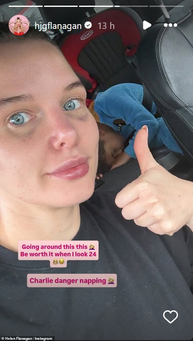 Helen Flanagan sported a painful black eye after undergoing a £400 beauty treatment this week