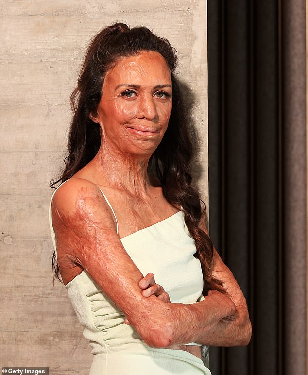 Burns survivor Turia Pitt (pictured) has revealed her new book