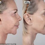 Leslie Ash, 65, has opened up about doing a £4,500 non-surgical face-lift that made her look 'ten years younger'